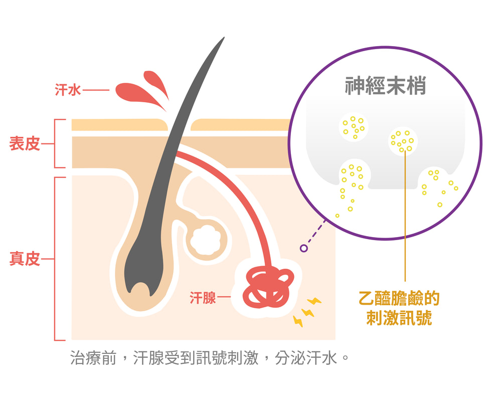 腋下汗腺治療前訊號刺激示意圖