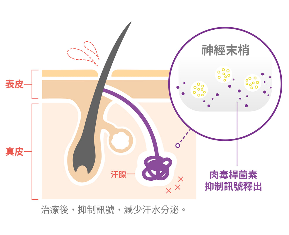 腋下肉毒治療後抑制訊號示意圖