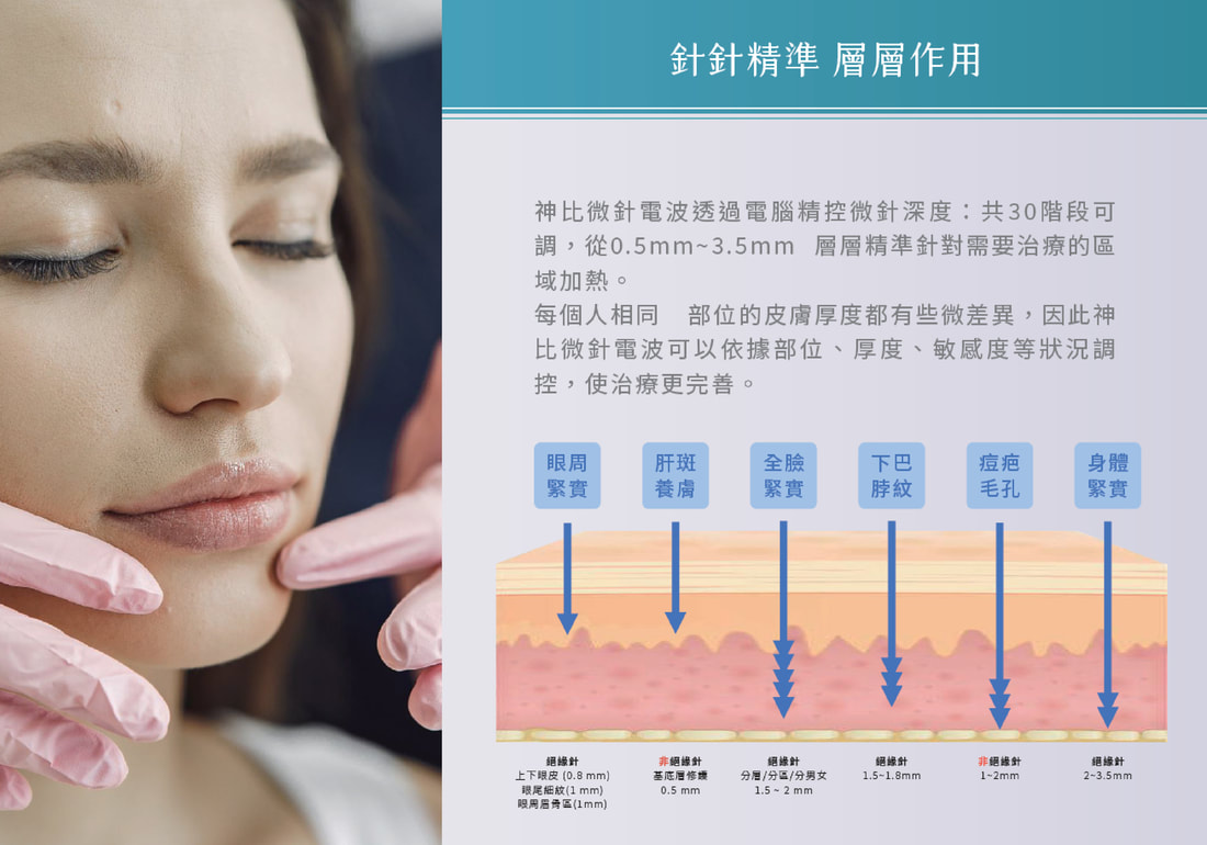 神比微針電波 圖片 8