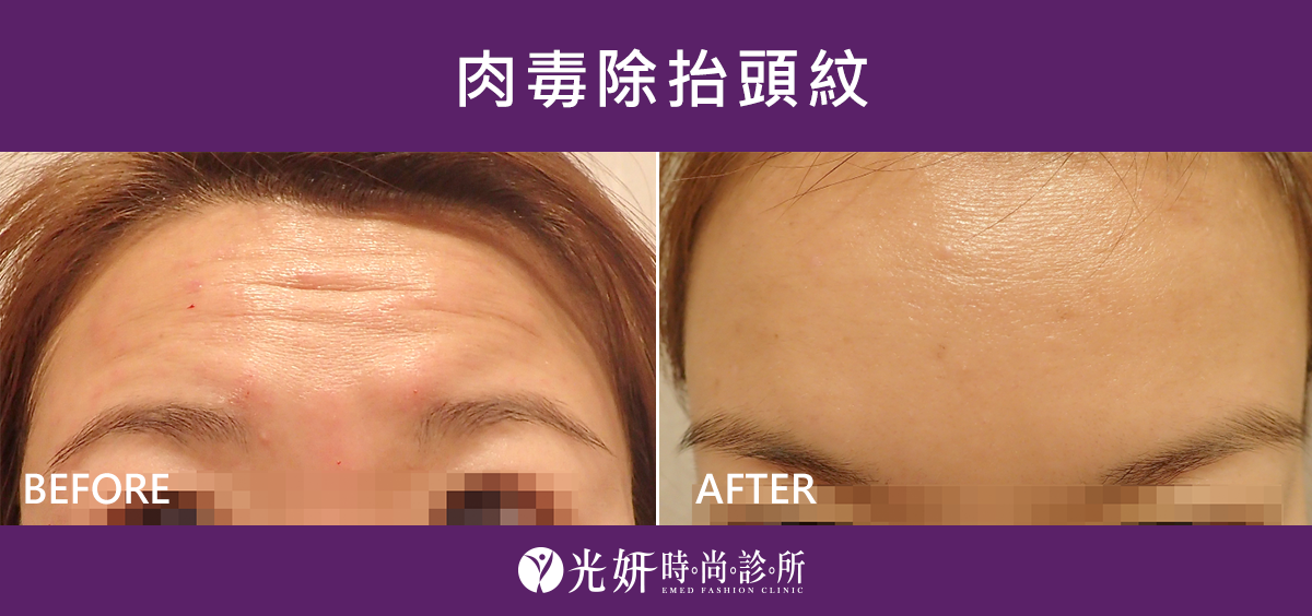 本院肉毒治療實例分享 圖片 2